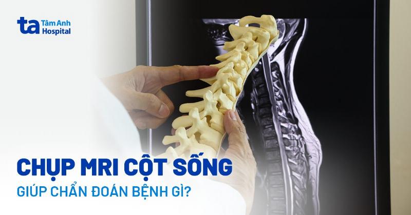 Hình Ảnh Xương Cột Sống MRI