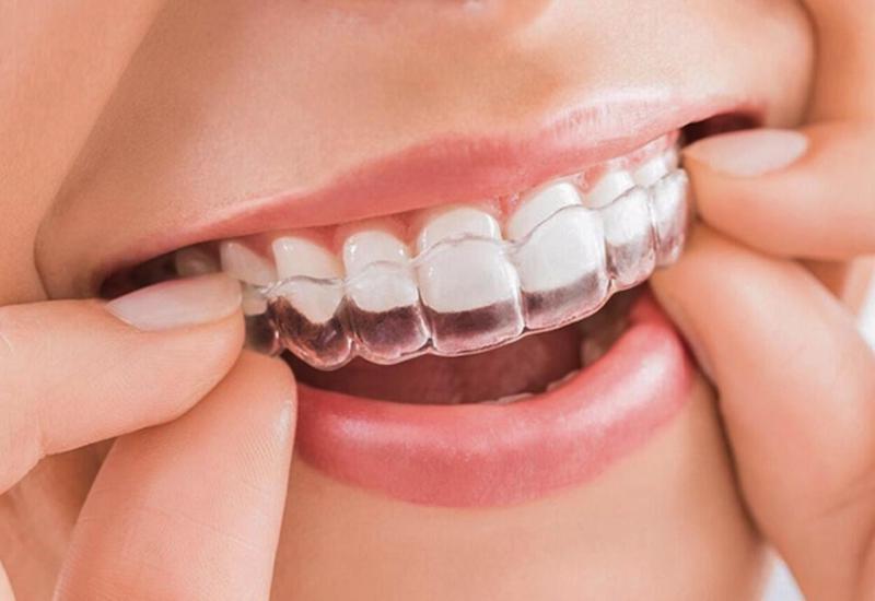 Invisalign là gì?