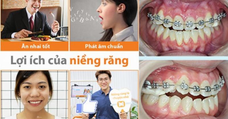 Lợi Ích Của Việc Niềng Răng: Sức Khỏe Và Thẩm Mỹ