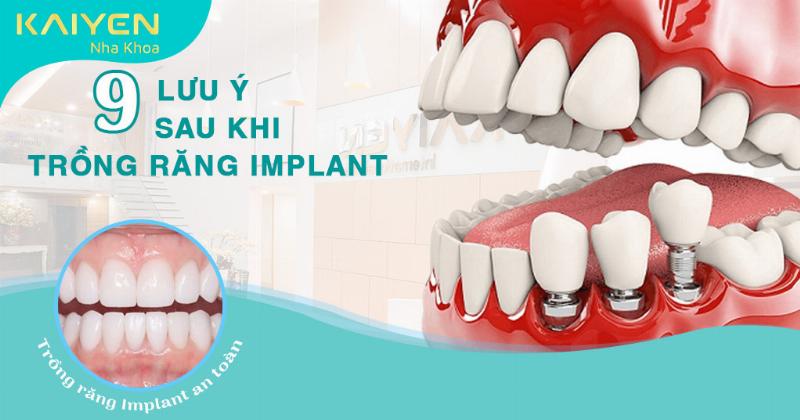 Những điều cần lưu ý khi trồng răng implant