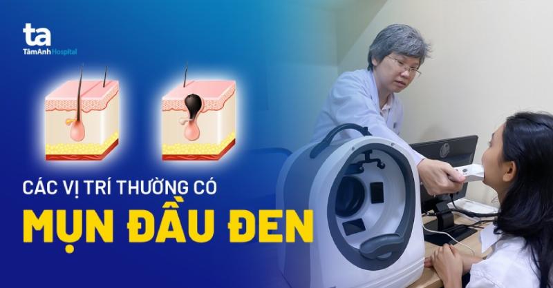 Mụn đầu đen hình thành như thế nào?