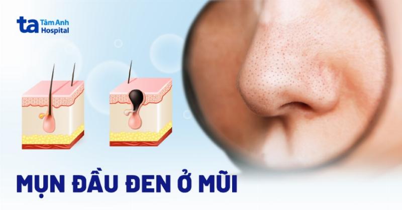 Mụn đầu đen ở mũi có tự hết không?