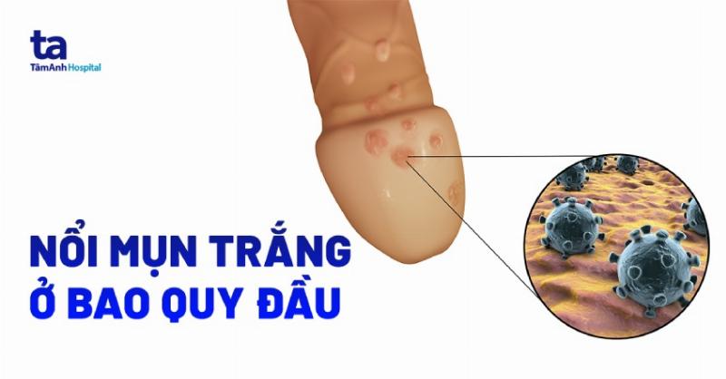 Tầm quan trọng của việc đi khám bác sĩ khi có mụn đầu trắng ở dương vật