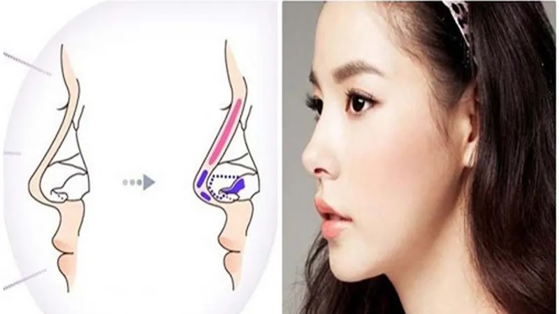 Những điều cần lưu ý khi nâng mũi sụn sườn