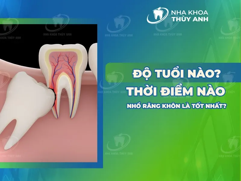 Nên Nhổ Răng Khôn Vào Lúc Nào?