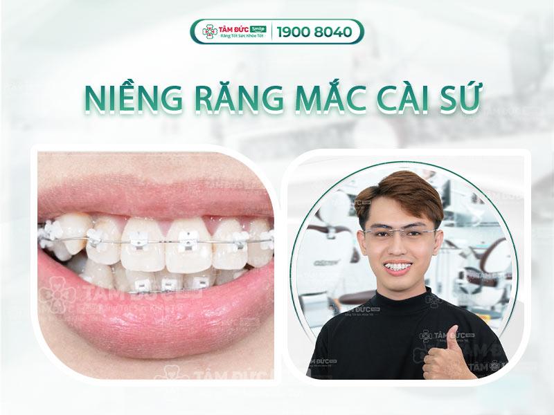 Niềng răng mắc cài sứ 1 hàm có tính thẩm mỹ cao