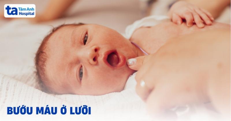 Nổi Cục Máu Ở Lưỡi Nguy Hiểm