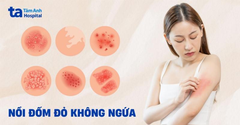 Nổi Đốm Đỏ Trên Da Không Ngứa: Biểu Hiện