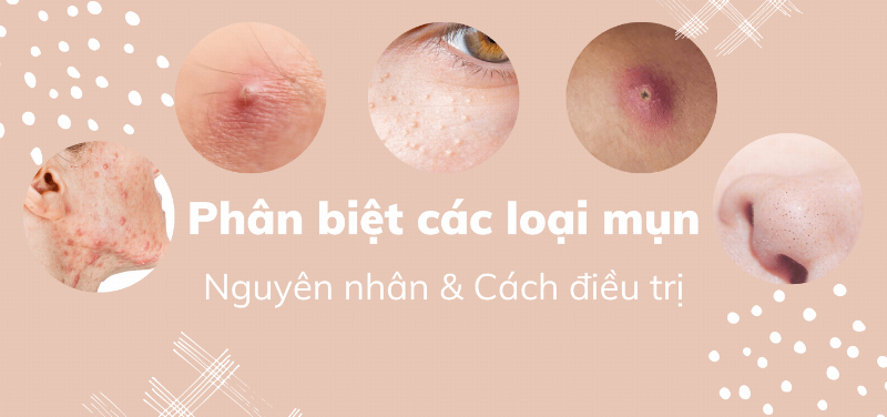 Phân biệt các loại mụn