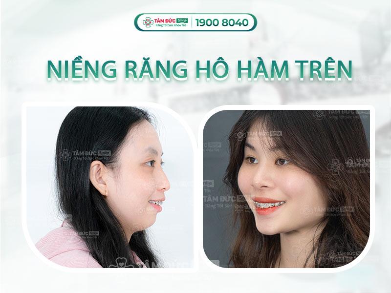 Quy trình niềng răng hô hàm trên tại Nha Khoa Bảo Anh