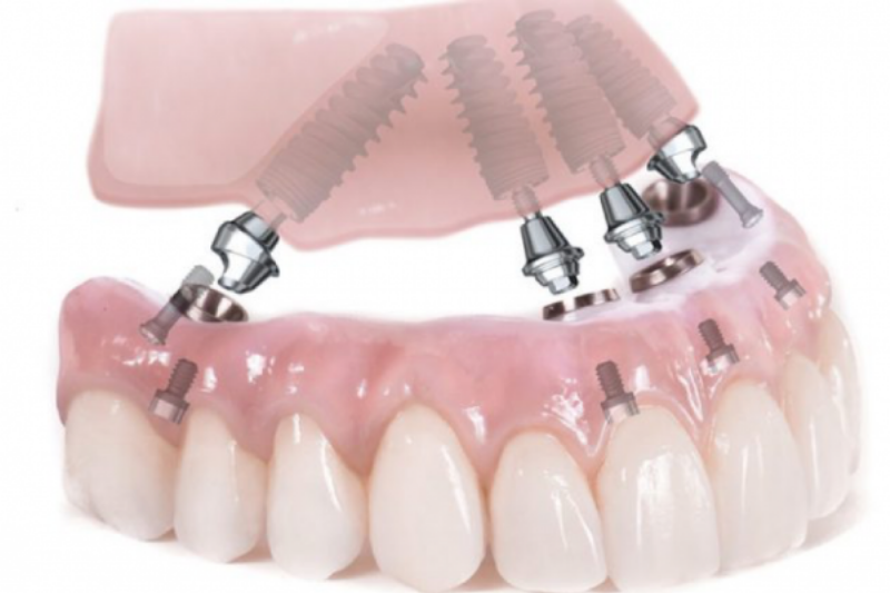 Quy trình trồng răng implant tại Nha Khoa Bảo Anh