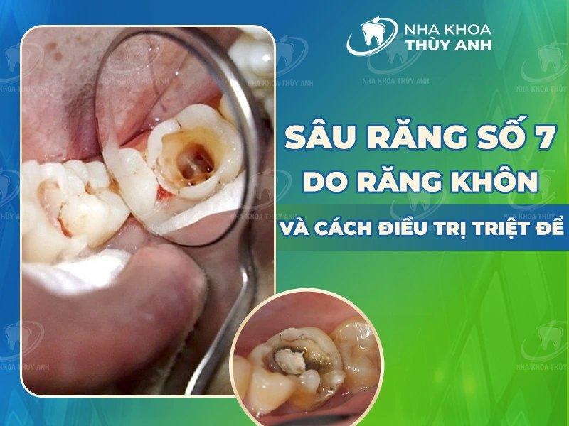 Sâu răng số 7 và răng khôn