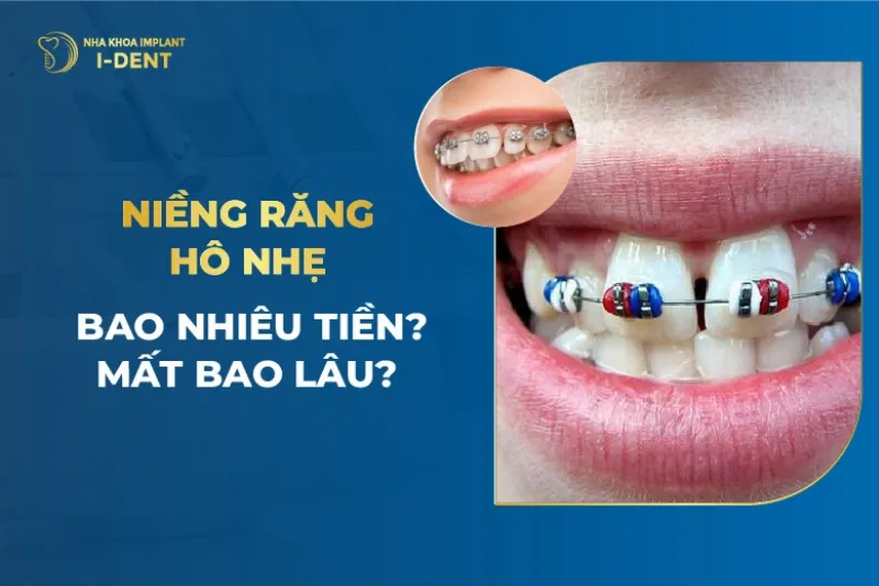 Các Giai Đoạn Niềng Răng Hô