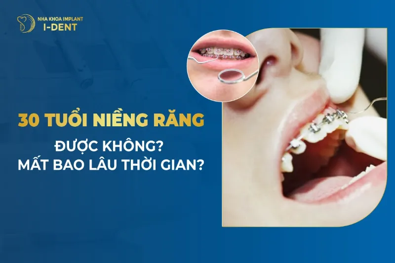 30 Tuổi Niềng Răng Mất Bao Lâu?