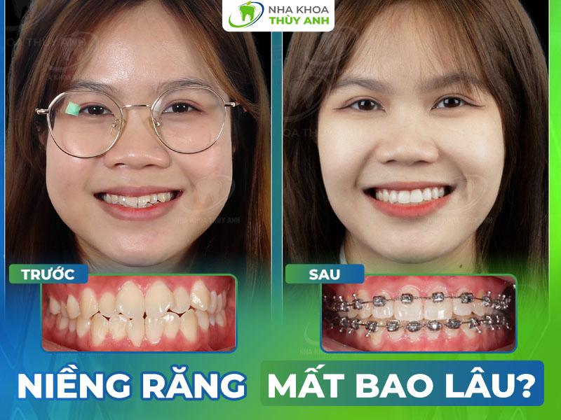 Niềng Răng Bao Lâu Thì Tháo? Giải Đáp Mọi Thắc Mắc