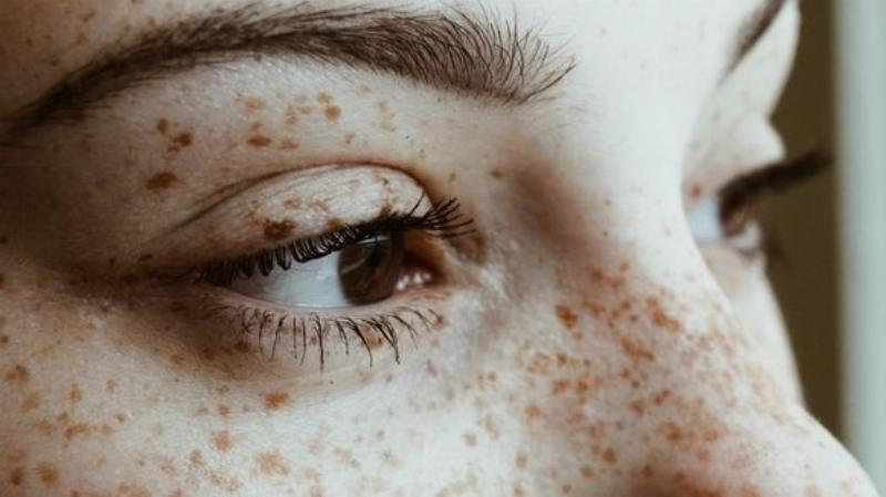 Bắn Tàn Nhang Bao Lâu Thì Hết Thâm?
