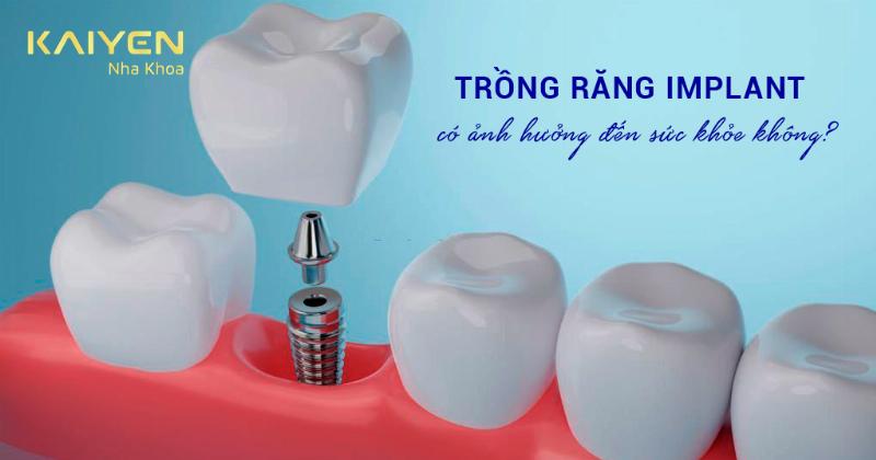 Hối Hận Khi Trồng Implant: Sự Thật Bạn Cần Biết