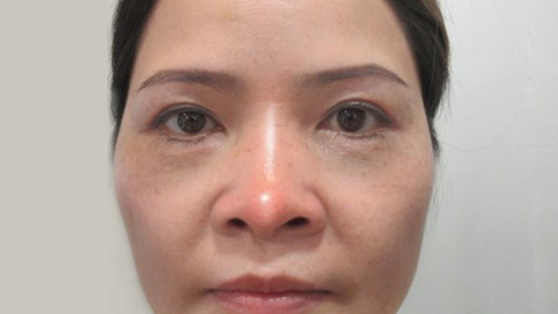 Tìm Địa Chỉ Nâng Mũi Uy Tín: Bí Quyết Cho Dáng Mũi Hoàn Hảo