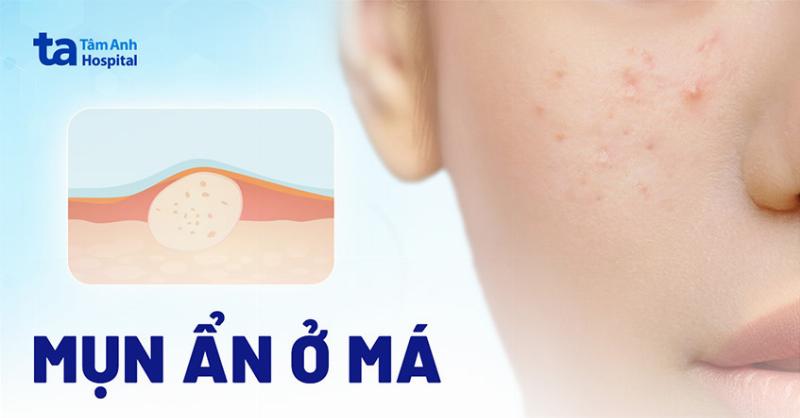 Tránh sờ tay lên mặt sau khi nặn mụn