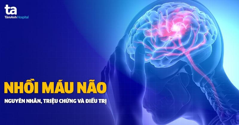 Triệu chứng Nhồi Máu Não