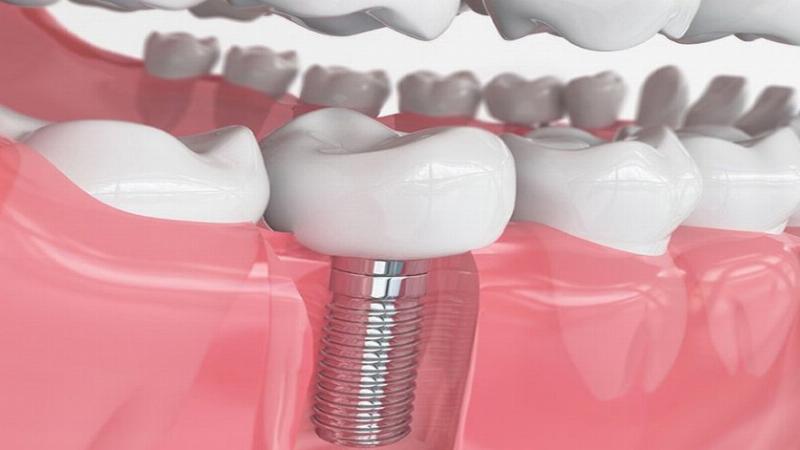 Trồng Răng Implant Sau Khi Nhổ Răng Số 7