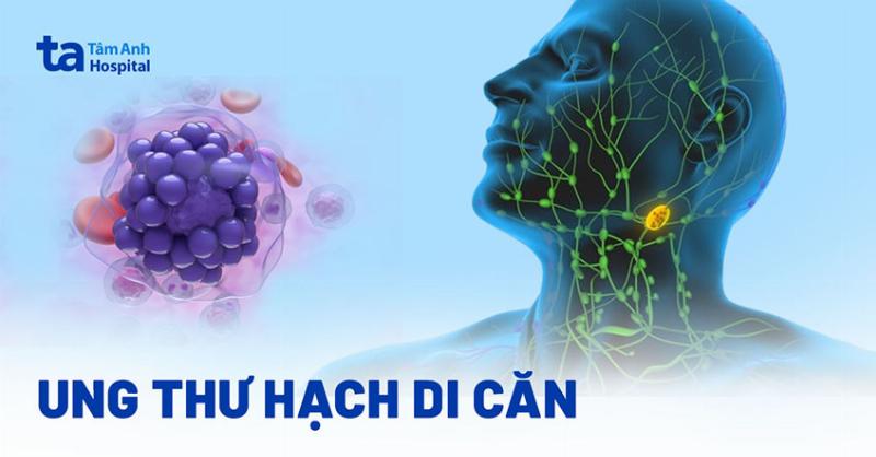 Ung Thư Hạch Di Căn: Phương Pháp Điều Trị