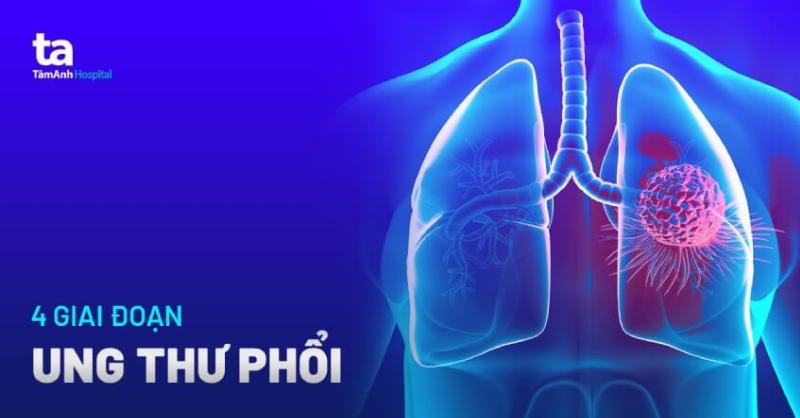 Hình ảnh ung thư phổi giai đoạn cuối đã lan rộng