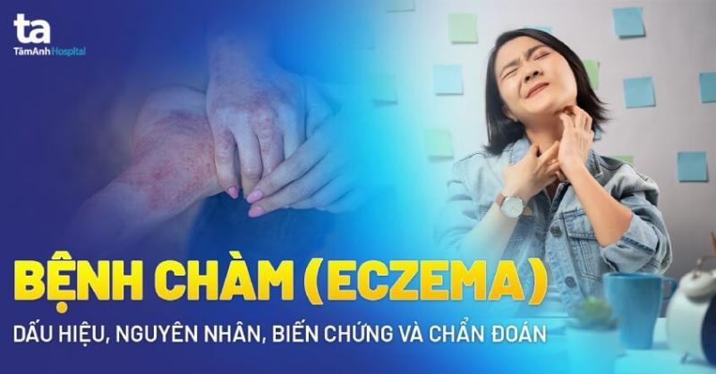 Viêm Da Cơ Địa (Eczema)