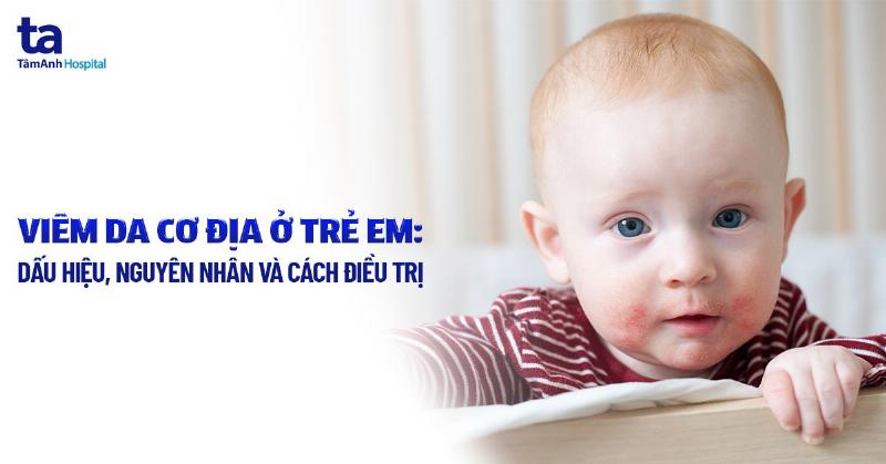 Điều trị viêm da cơ địa ở trẻ em