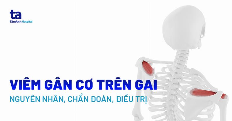 Viêm Gân Cơ Trên Gai Vai Phải: Nguyên Nhân, Triệu Chứng và Điều Trị