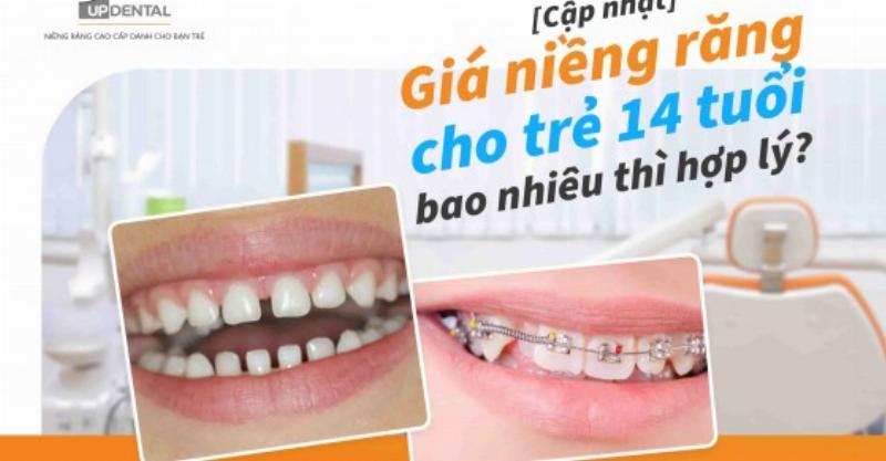 Bảng giá niềng răng 14 tuổi