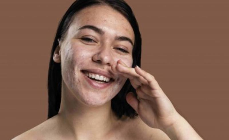 BHA có thực sự đẩy mụn?