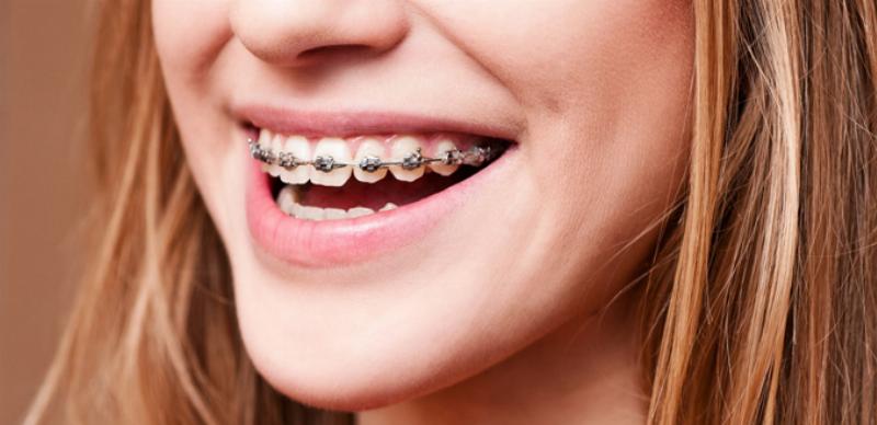 Câu hỏi thường gặp niềng răng 14 tuổi