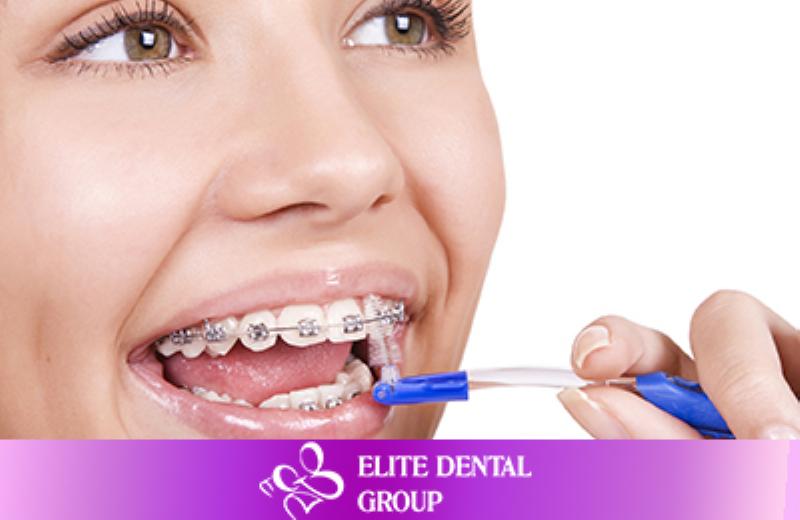 Chăm sóc răng miệng khi niềng răng