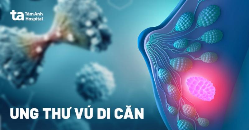 Chẩn đoán ung thư vú di căn