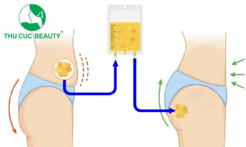 Cấy mỡ mông giữ được bao lâu?