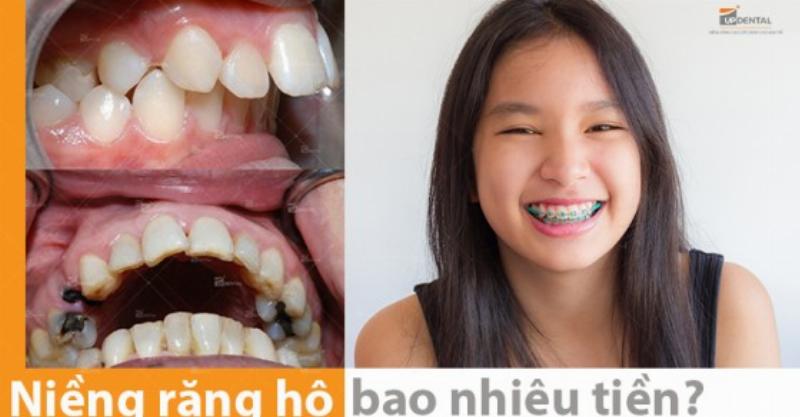 Chi phí niềng răng hô nhẹ phụ thuộc vào mức độ hô