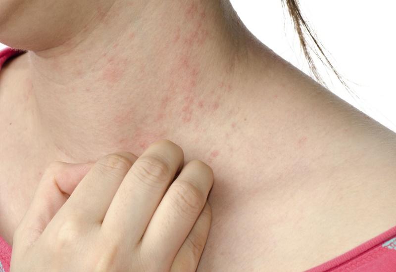 Dị ứng ngứa khắp người: Nguyên nhân và cách xử lý