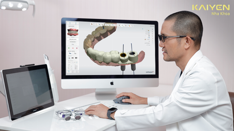 Các Giải Pháp Thay Thế Răng Đã Mất Hiệu Quả