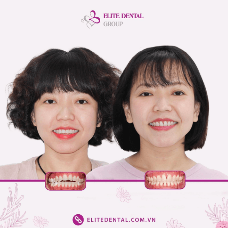 Kết quả niềng răng cải thiện khuôn mặt