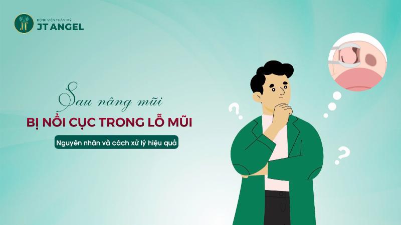 Mũi xuất hiện các cục u sau nâng mũi
