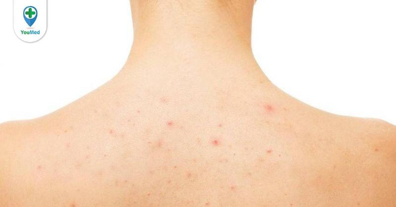 Mụn Lưng và Ngực: Nguyên Nhân và Cách Trị