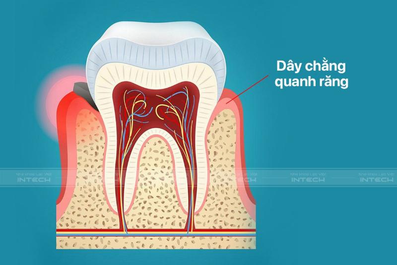 Niềng răng mắc cài hoạt động như thế nào?
