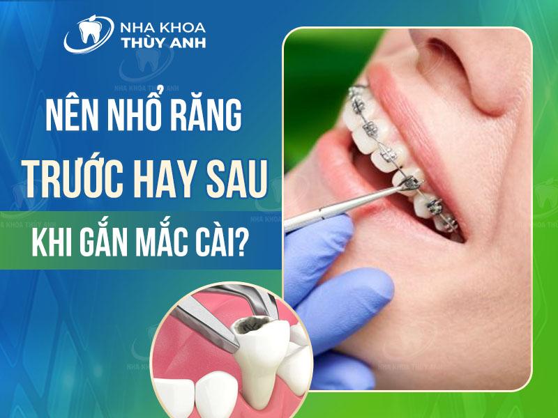 Niềng răng nhổ răng trước khi đeo mắc cài