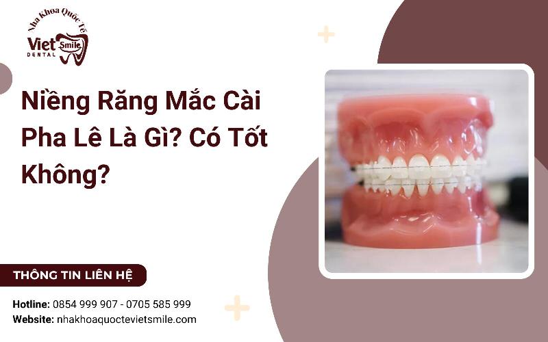 Niềng răng pha lê thay đổi khuôn mặt