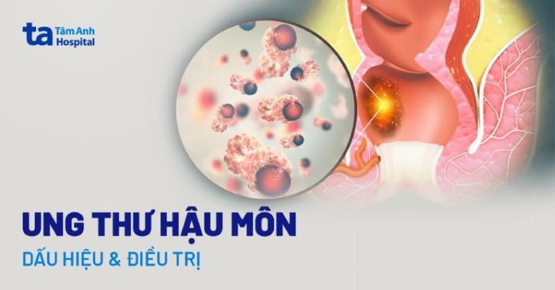 Làm Thế Nào Để Phòng Ngừa Ung Thư Hậu Môn?