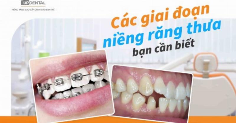 Quy trình niềng răng thưa