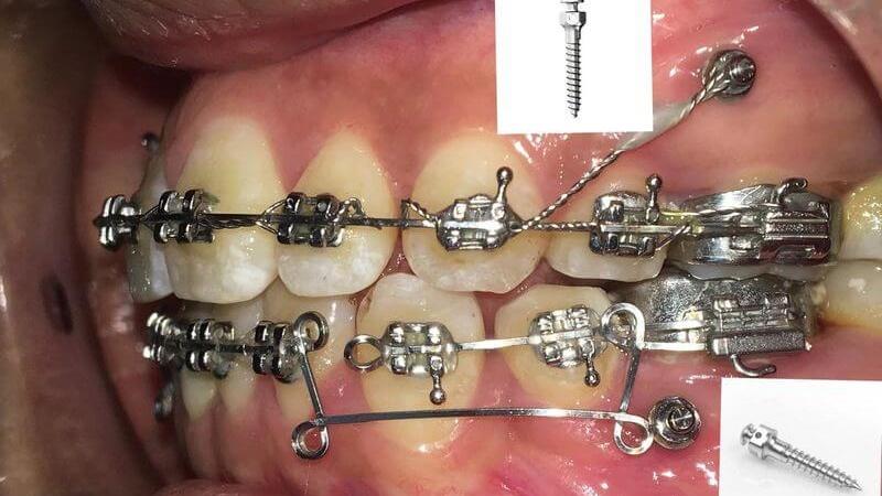 Cắm Vít Niềng Răng Bao Lâu Thì Tháo?