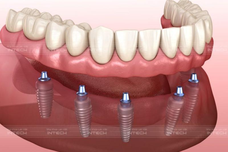 So sánh trồng răng Implant All on 4 với các phương pháp khác