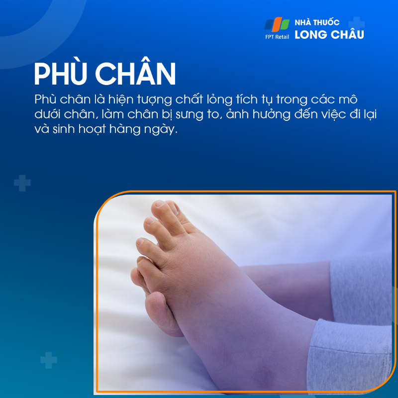 Chân sưng phù